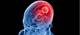 Novel Glioblastoma Treatment Granted Orphan Drug Designation Novel Glioblastoma Treatment Granted Orphan Drug Designation