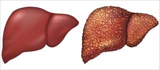 High Real-World Cure Rates With DAA Combo in HCV With Decompensated Cirrhosis High Real-World Cure Rates With DAA Combo in HCV With Decompensated Cirrhosis