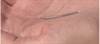FDA Puts New Restrictions on Permanent Birth Control Implant Essure FDA Puts New Restrictions on Permanent Birth Control Implant Essure