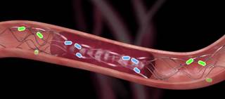 The Solitaire device uses a micro-sized catheter to access arteries in the brain The Solitaire device uses a micro-sized catheter to access arteries in the brain