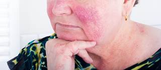 Phenotype-based treatments should be given for presenting signs and symptoms of rosacea Phenotype-based treatments should be given for presenting signs and symptoms of rosacea