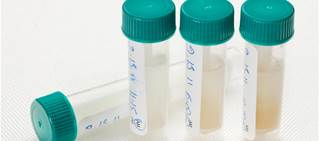 Higher amyloid-β protein levels in saliva were significantly associated with Alzheimer's patients Higher amyloid-β protein levels in saliva were significantly associated with Alzheimer's patients