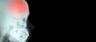 Researchers evaluated the risk for intracranial hemorrhage with the use of SSRIs vs. tricyclic antidepressants Researchers evaluated the risk for intracranial hemorrhage with the use of SSRIs vs. tricyclic antidepressants