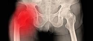 Inflammatory elements in the diets were compared to bone density and fractures Inflammatory elements in the diets were compared to bone density and fractures