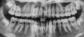 People who use it frequently twice as likely to have periodontal disease People who use it frequently twice as likely to have periodontal disease