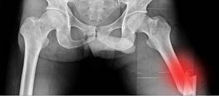 Increased risk of osteoporotic fracture with selective serotonin reuptake inhibitors, opioids of any strength Increased risk of osteoporotic fracture with selective serotonin reuptake inhibitors, opioids of any strength