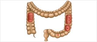 Metabolically unhealthy women have higher risk of colorectal cancer, researchers say Metabolically unhealthy women have higher risk of colorectal cancer, researchers say