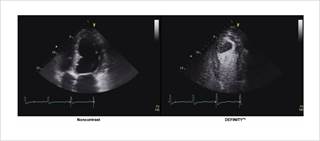 Warnings and Precautions have been updated with information about administration in patients with a cardiac shunt Warnings and Precautions have been updated with information about administration in patients with a cardiac shunt