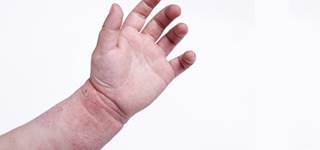Findings among newborns vaccinated within 7 days of birth Findings among newborns vaccinated within 7 days of birth