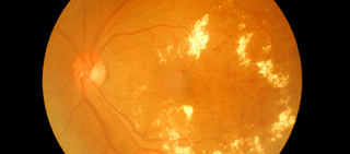 ADA releases updated diabetic retinopathy guidelines ADA releases updated diabetic retinopathy guidelines