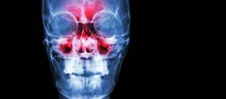 A total of 323 patients with CRSwNP and moderate-severe congestion were enrolled in the 24-week study A total of 323 patients with CRSwNP and moderate-severe congestion were enrolled in the 24-week study