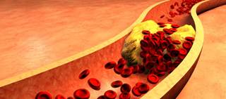 As well as improving CAD accuracy, this novel blood test has the potential to lower medical testing costs As well as improving CAD accuracy, this novel blood test has the potential to lower medical testing costs