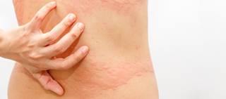 Enrolled patients with chronic idiopathic urticaria were given omalizumab 300mg SC every 4 weeks Enrolled patients with chronic idiopathic urticaria were given omalizumab 300mg SC every 4 weeks