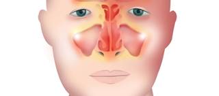 Mepolizumab is an approved agent for SEA but it is not clear whether coexisting nasal polyps affect efficacy Mepolizumab is an approved agent for SEA but it is not clear whether coexisting nasal polyps affect efficacy