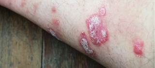 Case report: After initiation of ledipasvir-sofosbuvir, HCV RNA decreased, and skin lesions improved Case report: After initiation of ledipasvir-sofosbuvir, HCV RNA decreased, and skin lesions improved