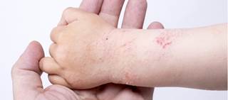 Probiotics in first six months of life do not reduce incidence of eczema at age 2, asthma at age 5 Probiotics in first six months of life do not reduce incidence of eczema at age 2, asthma at age 5