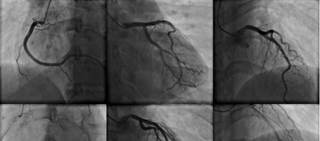 Correlation between CTA and later major adverse events ID'd in large population of outpatients with stable chest pain Correlation between CTA and later major adverse events ID'd in large population of outpatients with stable chest pain