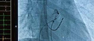 Anticoagulation pre- during- and post-ablation must be managed carefully to minimize risks of thromboembolism and bleeding Anticoagulation pre- during- and post-ablation must be managed carefully to minimize risks of thromboembolism and bleeding