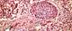 Positive Top-Line Results for Ramucirumab in HCC Announced Positive Top-Line Results for Ramucirumab in HCC Announced