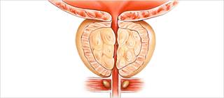 Outcome of dementia among prostate cancer patients exposed to ADT were analyzed in the study Outcome of dementia among prostate cancer patients exposed to ADT were analyzed in the study