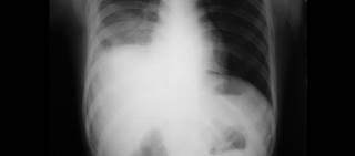 Empyema, an accumulation of pus around the lungs, typically occurs as a complication of pneumonia Empyema, an accumulation of pus around the lungs, typically occurs as a complication of pneumonia