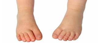 The approval of Brineura was based on data from a 96-week study that included 64 infants The approval of Brineura was based on data from a 96-week study that included 64 infants
