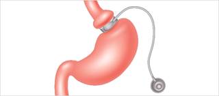 The patient's past medical history includes type 2 diabetes mellitus, hypertension, dyslipidemia, and morbid obesity The patient's past medical history includes type 2 diabetes mellitus, hypertension, dyslipidemia, and morbid obesity