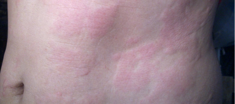 Adding A Steroid May Not Be Necessary In Acute Urticaria Management Mpr