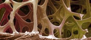 Reduced bone mineral density and increased fracture risk are both associated with HIV and antiretroviral Tx Reduced bone mineral density and increased fracture risk are both associated with HIV and antiretroviral Tx