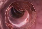 Flexible Sigmoidoscopy Cuts CRC Incidence, Mortality in Men Flexible Sigmoidoscopy Cuts CRC Incidence, Mortality in Men