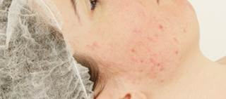 Mechanical dermabrasion and fully ablative laser not recommended in setting of systemic treatment Mechanical dermabrasion and fully ablative laser not recommended in setting of systemic treatment