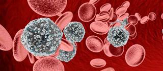 Case report describes smoker with HIV infection receiving nivolumab for non-small-cell lung cancer Case report describes smoker with HIV infection receiving nivolumab for non-small-cell lung cancer