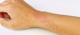 Steroid-sparing systemic agents may be a better long-term option for severe atopic dermatitis Steroid-sparing systemic agents may be a better long-term option for severe atopic dermatitis