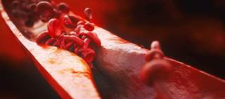 LDL-C independently associated with the presence and extent of atherosclerosis LDL-C independently associated with the presence and extent of atherosclerosis