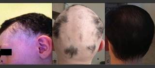 Two cases detail men who experienced hair regrowth following fecal microbiota transplantation. Credit: Rebello et al. Two cases detail men who experienced hair regrowth following fecal microbiota transplantation. Credit: Rebello et al.