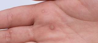 Oral treatment shows better, earlier response than topical isotretinoin Oral treatment shows better, earlier response than topical isotretinoin