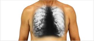 The NDA is for the treatment of non-cystic fibrosis bronchiectasis patients with chronic infections with P. aeruginosa The NDA is for the treatment of non-cystic fibrosis bronchiectasis patients with chronic infections with P. aeruginosa
