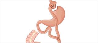 Studies show no significant difference in BMI loss at five years between these laparoscopic procedures Studies show no significant difference in BMI loss at five years between these laparoscopic procedures
