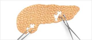 And, pre-op chemoradiotherapy linked to longer overall survival than immediate surgery. And, pre-op chemoradiotherapy linked to longer overall survival than immediate surgery.