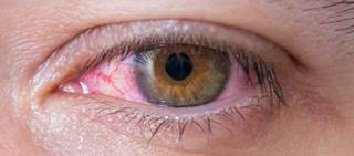 Researchers found prasugrel has no increased ocular risk vs. clopidogrel Researchers found prasugrel has no increased ocular risk vs. clopidogrel
