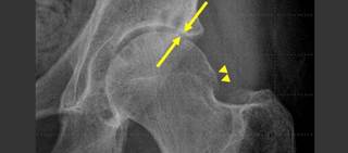Participants received X-ray images of the hip at the time of injection and then at a follow-up between 3 and 9 months later Participants received X-ray images of the hip at the time of injection and then at a follow-up between 3 and 9 months later