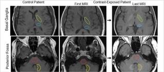 Researchers aimed to ID the neurotoxic potential of gadolinium accumulation after IV administration of gadolinium-based contrast media Researchers aimed to ID the neurotoxic potential of gadolinium accumulation after IV administration of gadolinium-based contrast media