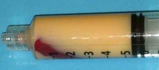 Representative, "Crisco-like" blood draw of a patient with severely elevated triglycerides (Reprinted with permission from the Hawai'i Journal of Medicine & Public Health) Representative, "Crisco-like" blood draw of a patient with severely elevated triglycerides (Reprinted with permission from the Hawai'i Journal of Medicine & Public Health)