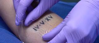 The Patch allows physicians to treat tattoos more efficiently by enabling rapid multiple laser passes in a single treatment session. The Patch allows physicians to treat tattoos more efficiently by enabling rapid multiple laser passes in a single treatment session.