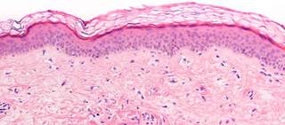 Two studies evaluate use; one for breast cancer, the other for diabetic retinopathy Two studies evaluate use; one for breast cancer, the other for diabetic retinopathy