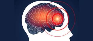 Famciclovir + celecoxib may work synergistically to treat migraine disorder Famciclovir + celecoxib may work synergistically to treat migraine disorder