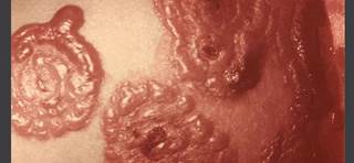 Stevens-Johnson syndrome is a severe skin reaction often triggered by certain medications (Image courtesy of CDC) Stevens-Johnson syndrome is a severe skin reaction often triggered by certain medications (Image courtesy of CDC)