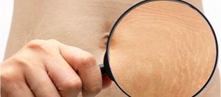 Patients received a PRP injection in the right side and a carboxytherapy session in the left side every 3 to 4 weeks for 4 sessions Patients received a PRP injection in the right side and a carboxytherapy session in the left side every 3 to 4 weeks for 4 sessions