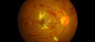 Persistent diabetic macular edema more likely with bevacizumab than aflibercept or ranibizumab Persistent diabetic macular edema more likely with bevacizumab than aflibercept or ranibizumab