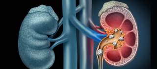 Dyslipidemia is an independent risk factor for urolithiasis Dyslipidemia is an independent risk factor for urolithiasis